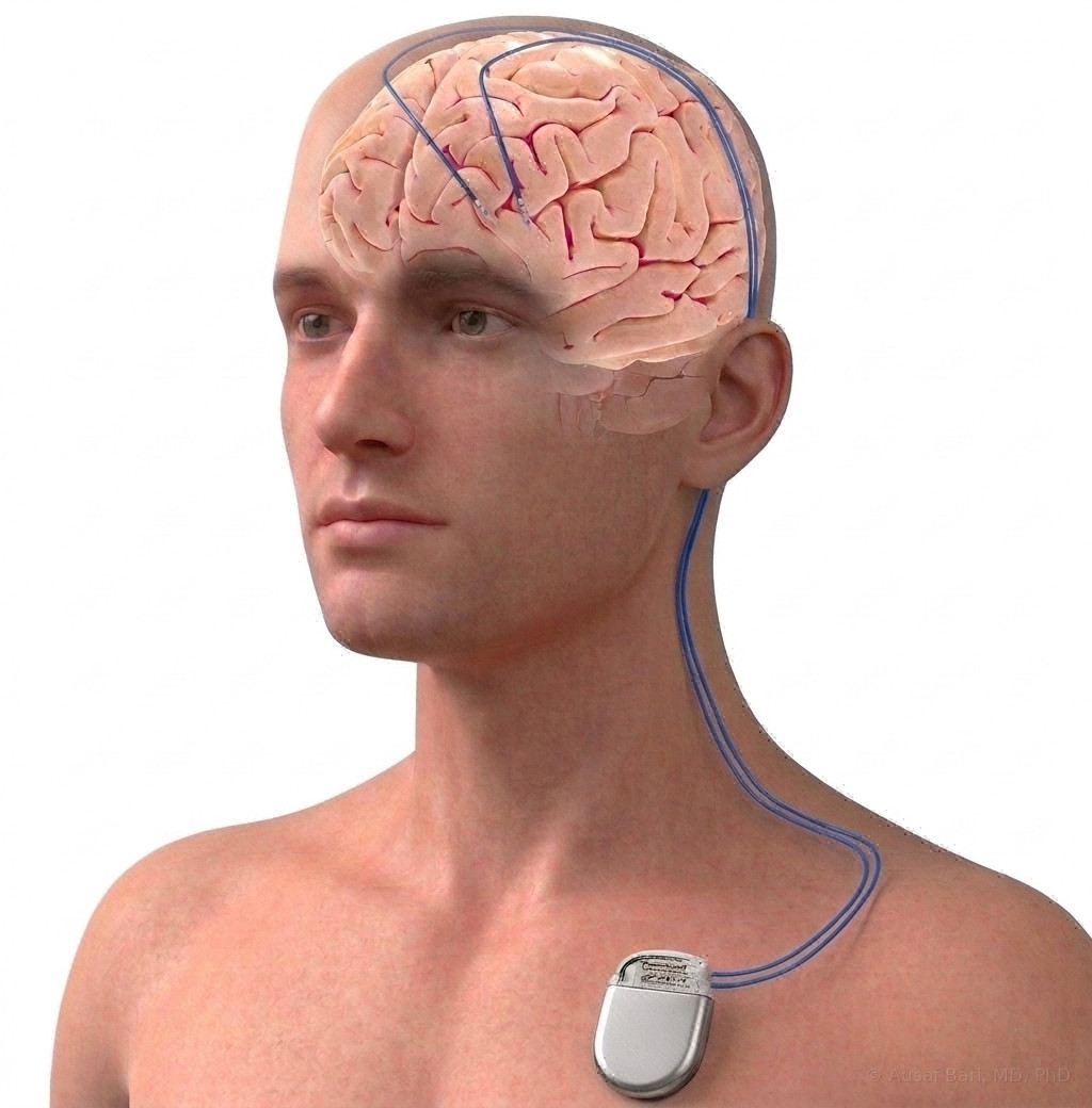 Illustration of a deep brain stimulation system: two thin leads entering the brain through the top of the skull, running under the skin behind the ear and down the neck to a pulse generator implanted below the collarbone
