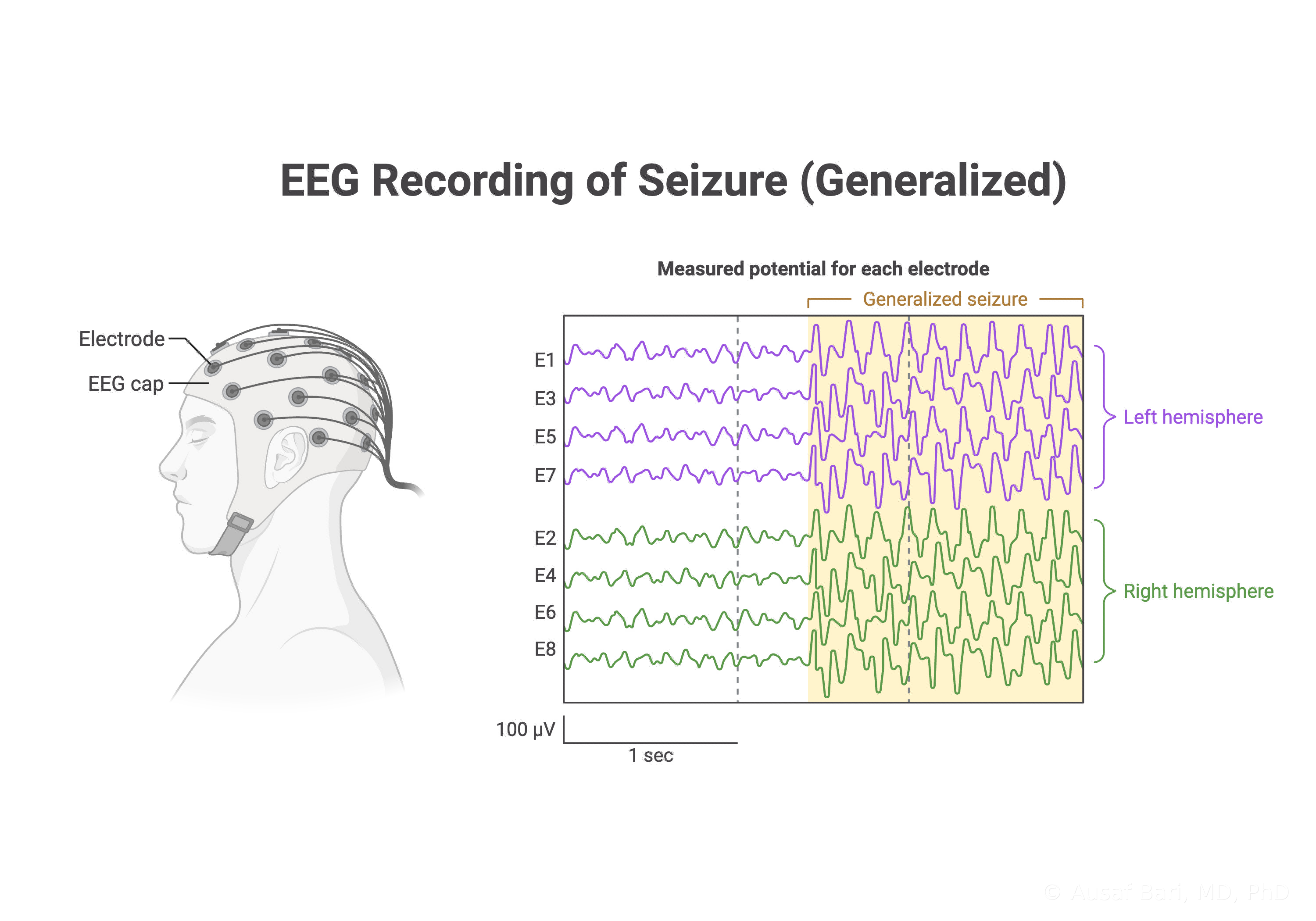 Illustration of an EEG cap on a patient beside eight EEG traces from both hemispheres, showing normal background rhythm changing to the large rhythmic waves of a generalized seizure
