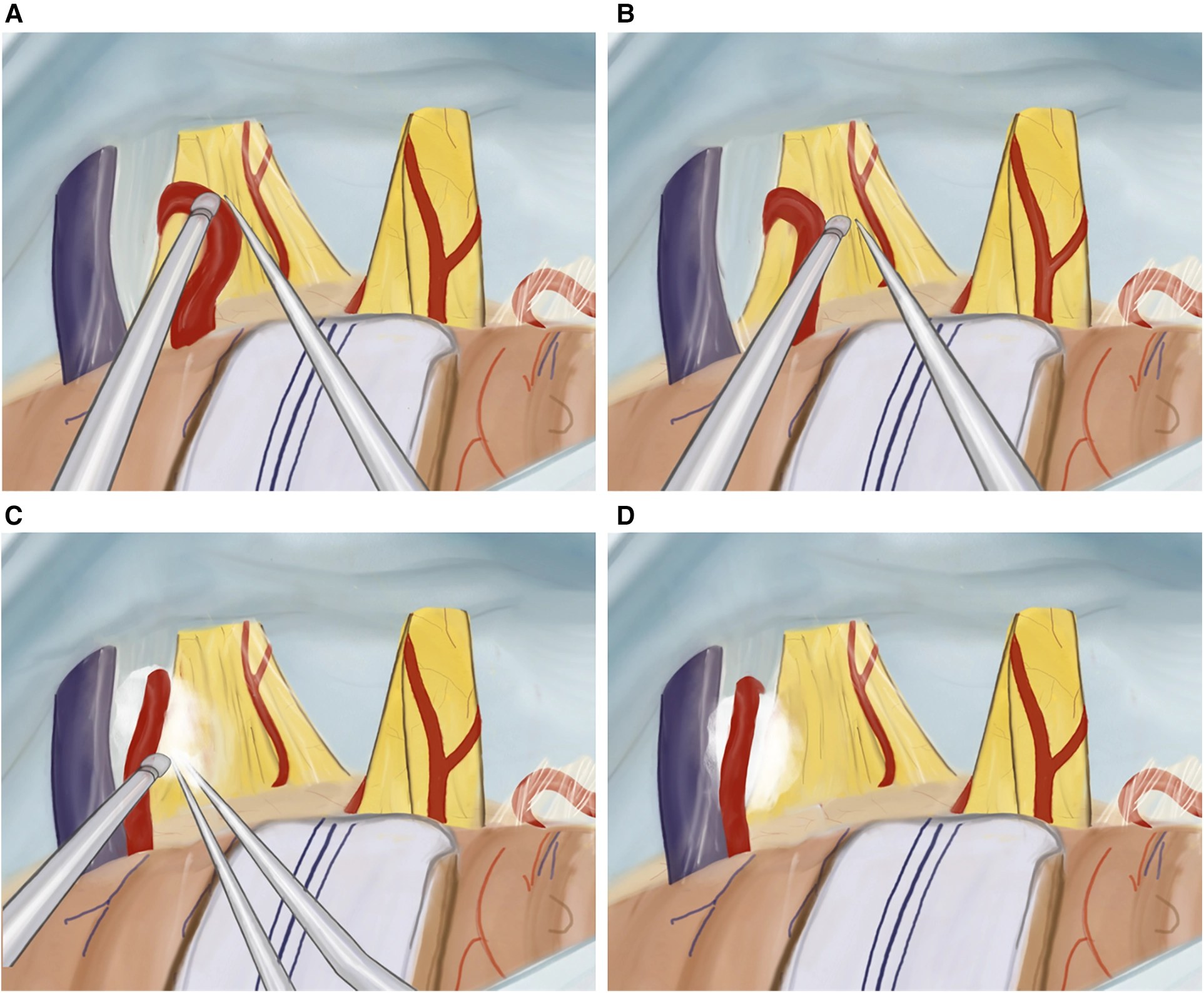 Four-panel surgical illustration: an artery lying on the trigeminal nerve, the artery being moved, a Teflon pad placed between them, and the decompressed nerve