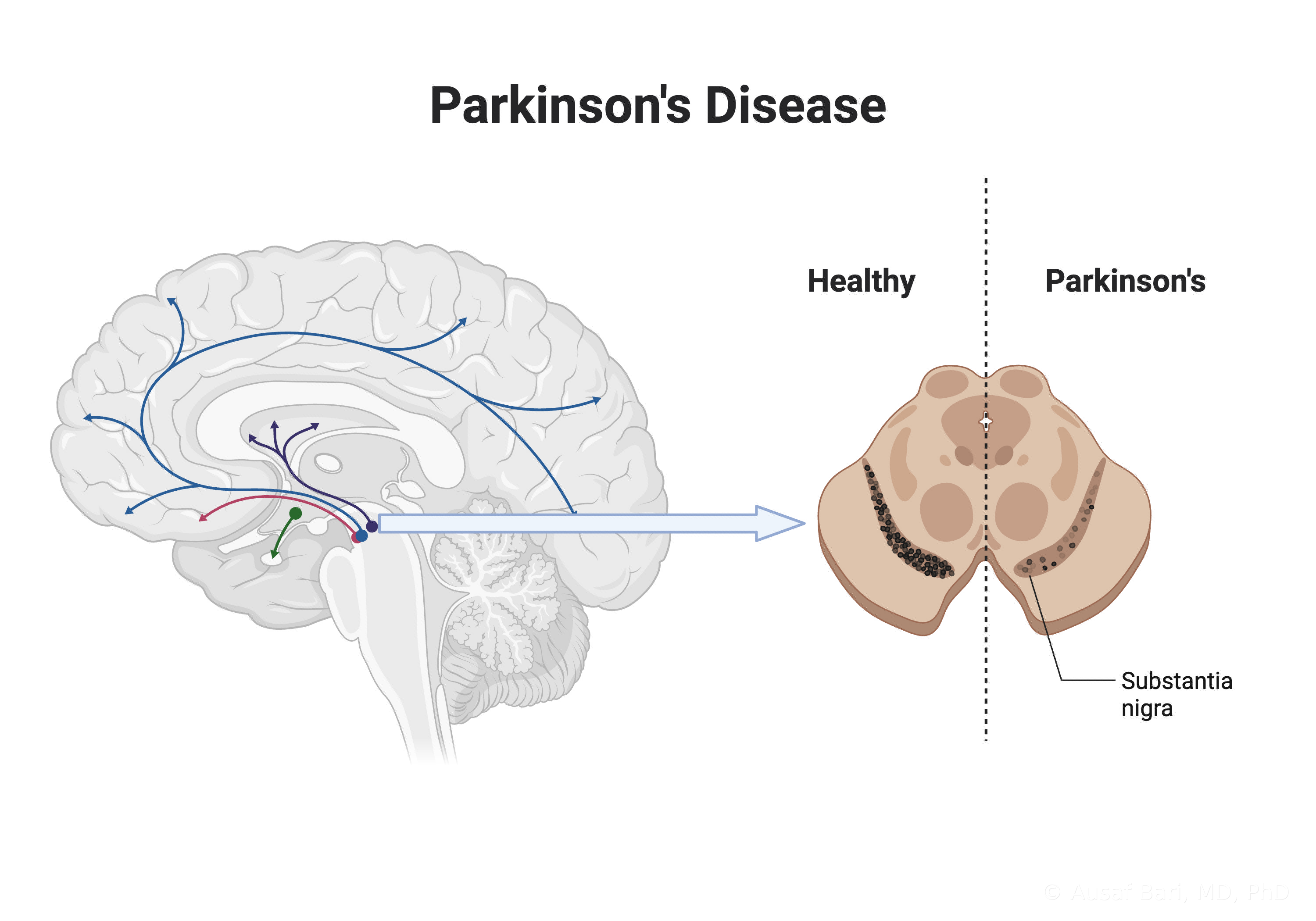 Illustration of the brain’s dopamine pathways rising from the midbrain, with a cross-section comparing the dark substantia nigra in a healthy brain to its faded appearance in Parkinson’s disease