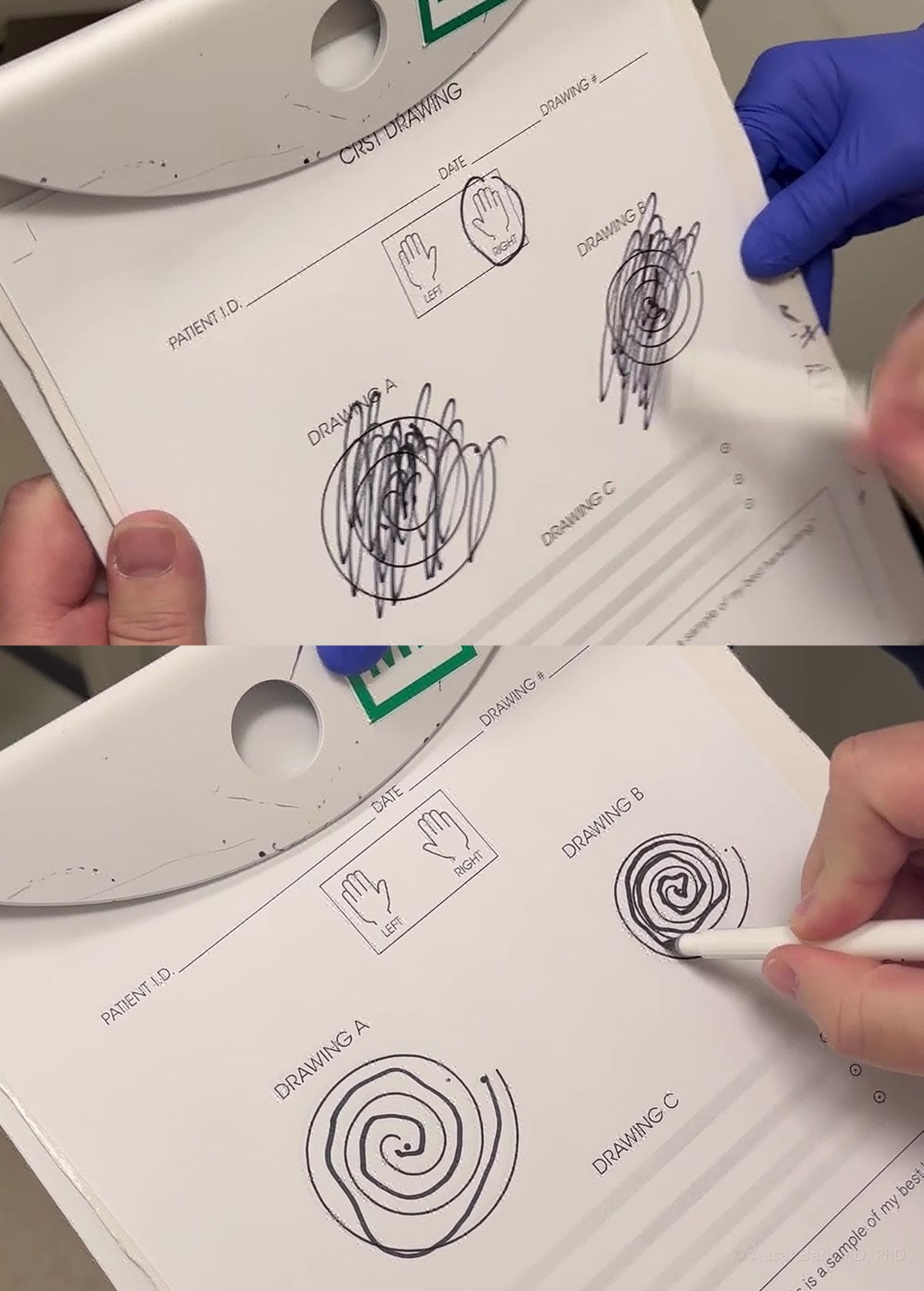 Spirals drawn by one of Dr. Bari’s patients with essential tremor: broken, shaky loops before treatment on top and smooth spirals after treatment below