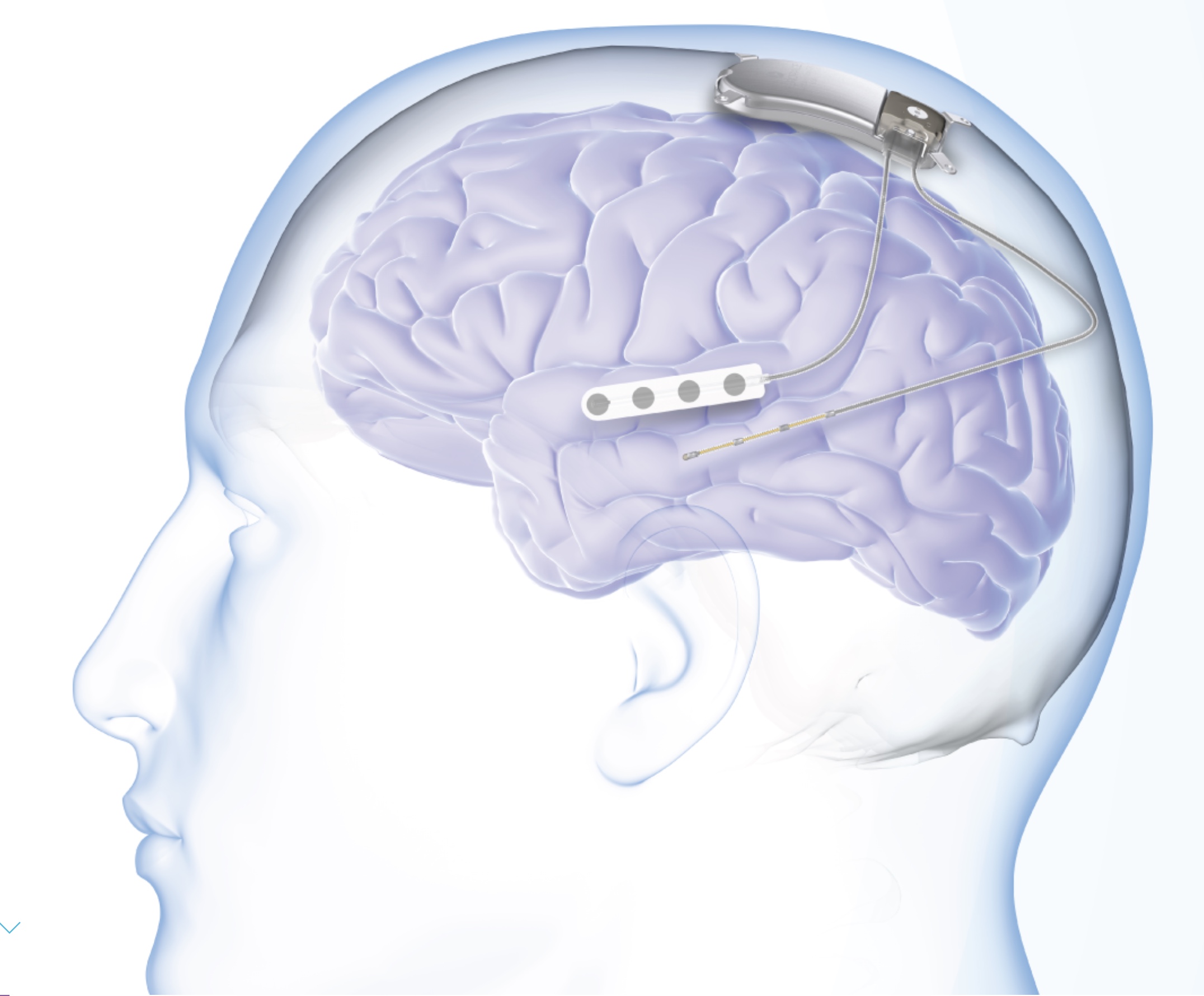 Responsive neurostimulation device in the skull connected to leads at the brain