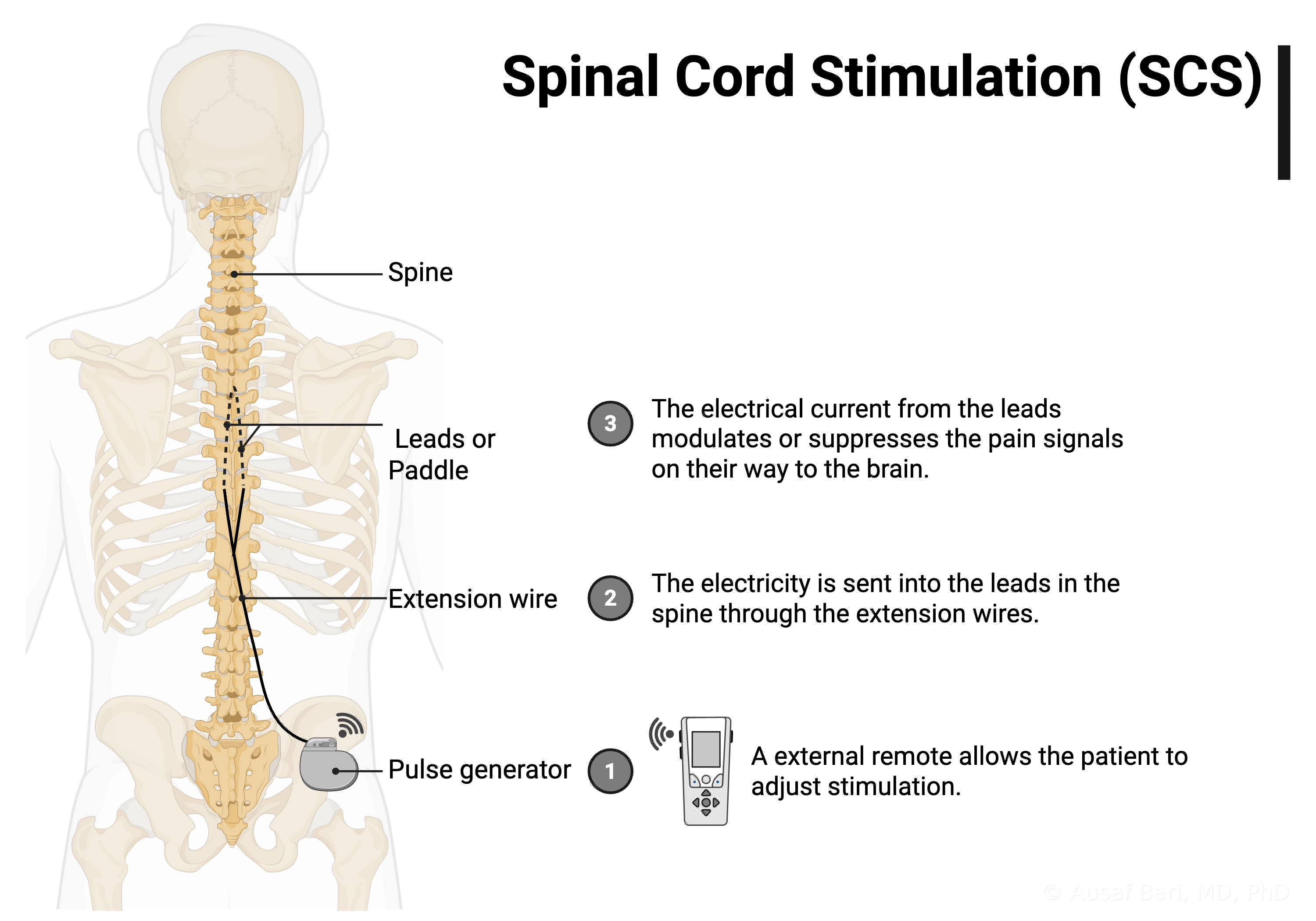 Illustration of a spinal cord stimulation system from behind: leads along the spine, an extension wire, a pulse generator in the lower back, and a handheld remote