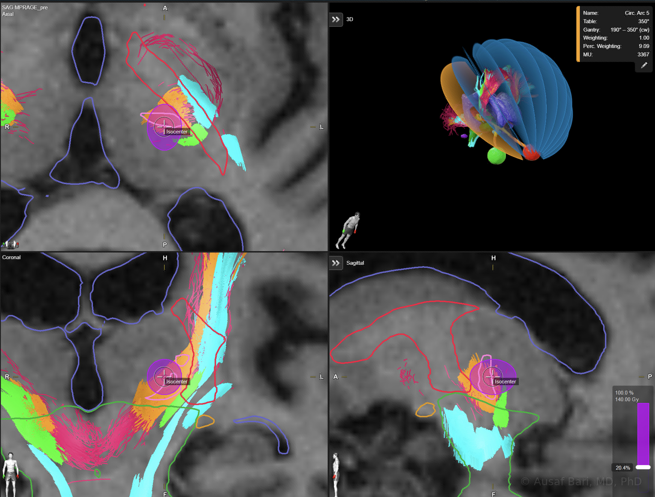 Radiosurgery planning screen for a thalamotomy: axial, coronal, and sagittal MRI with the target isocenter, surrounding fiber tracts in color, and a 3D view of the radiation arcs converging on the target