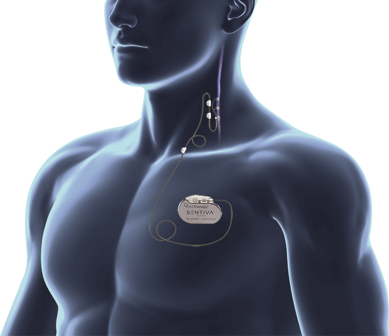 Illustration of a person with a VNS Therapy generator under the skin of the upper chest and its lead running up to the left vagus nerve in the neck